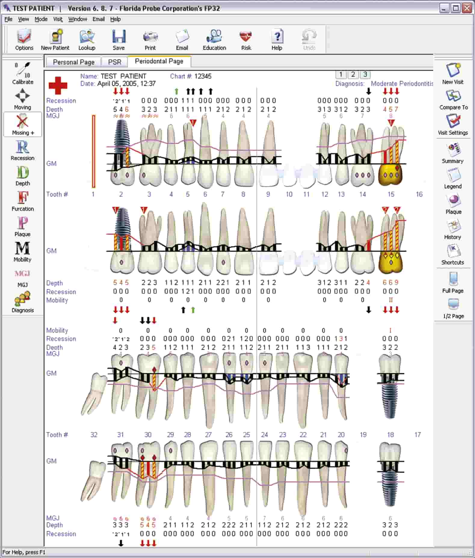 ᐈ Sonda Florida y Sonda Periodontal 🥇🥇