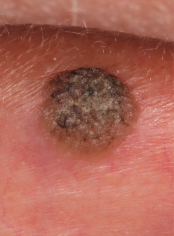 Diphenhydramine (Benadryl) as Local Anesthetic for Novocaine Allergy