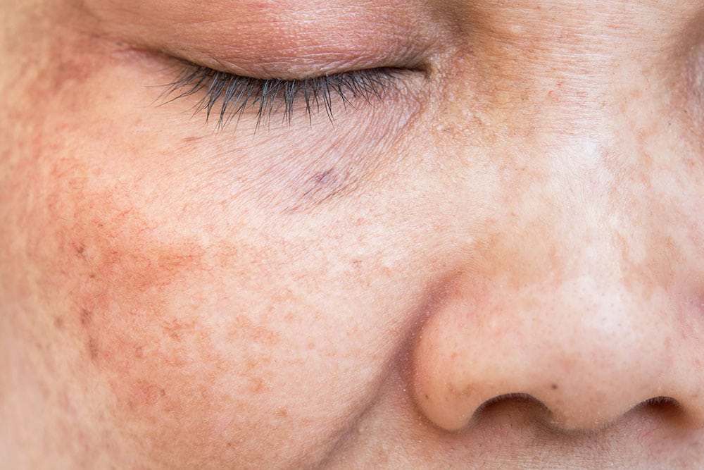Sun Damage Face Treatment in Denver, Colorado Orenda MedSpa