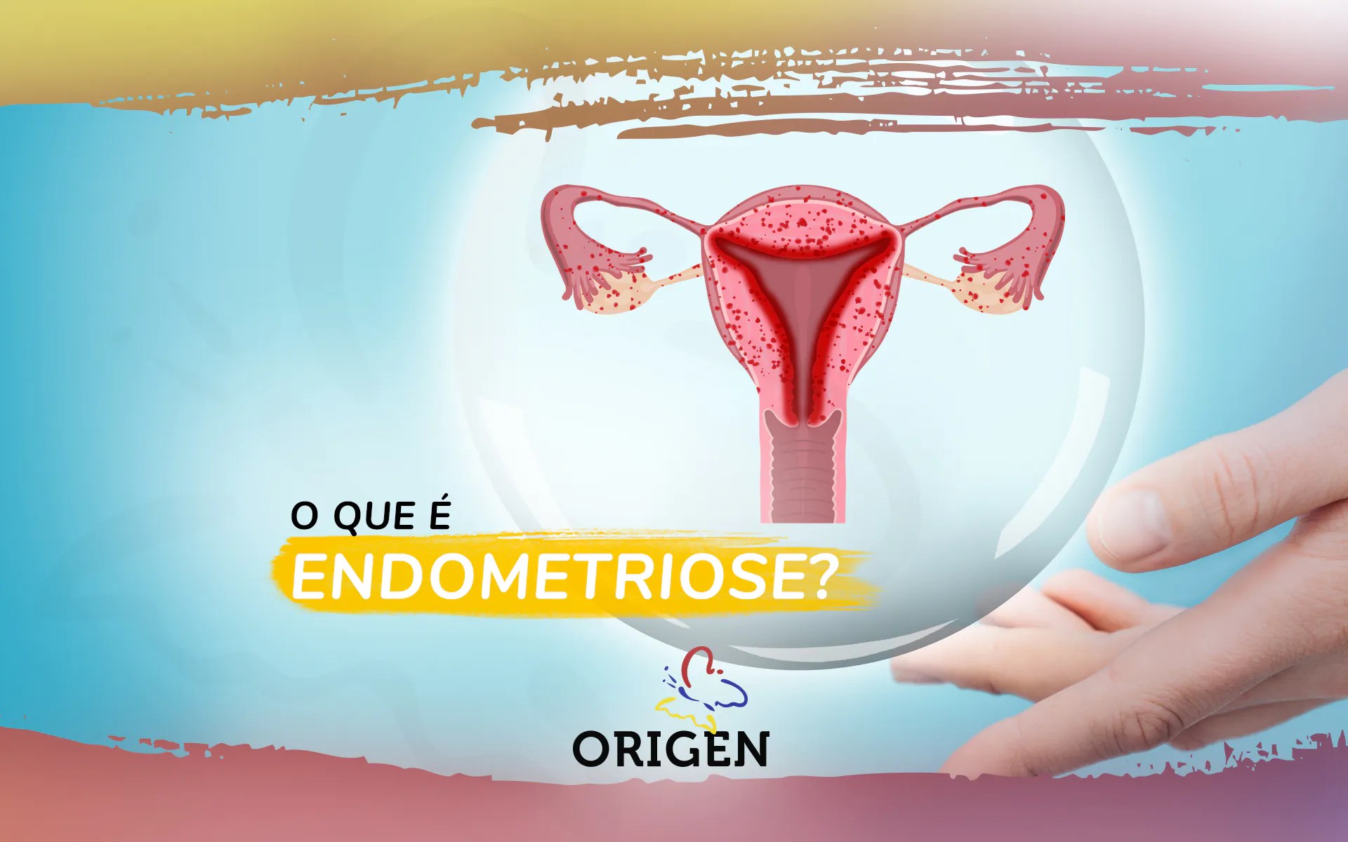 » O que é endometriose?
