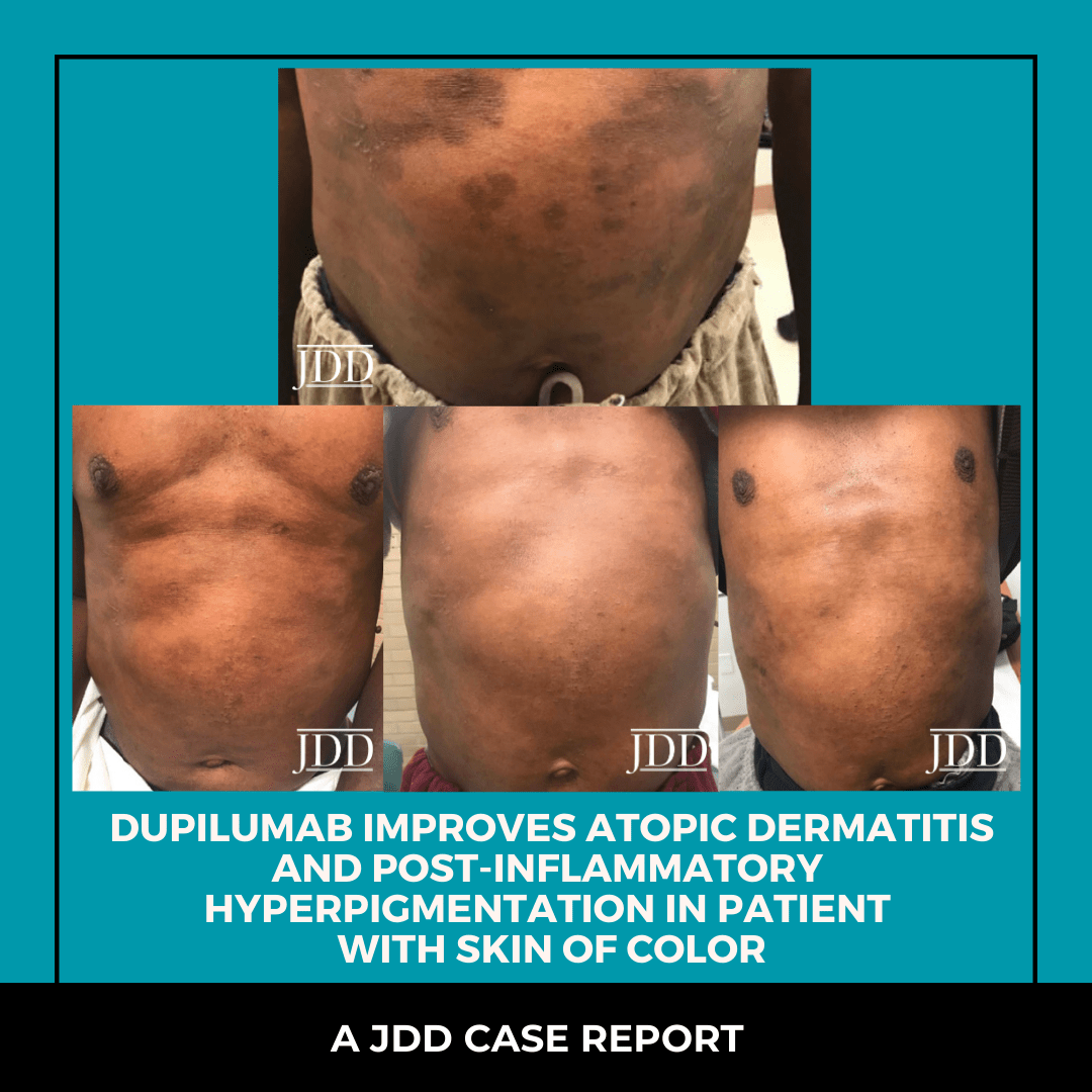 Dupilumab Improves Atopic Dermatitis and PostInflammatory