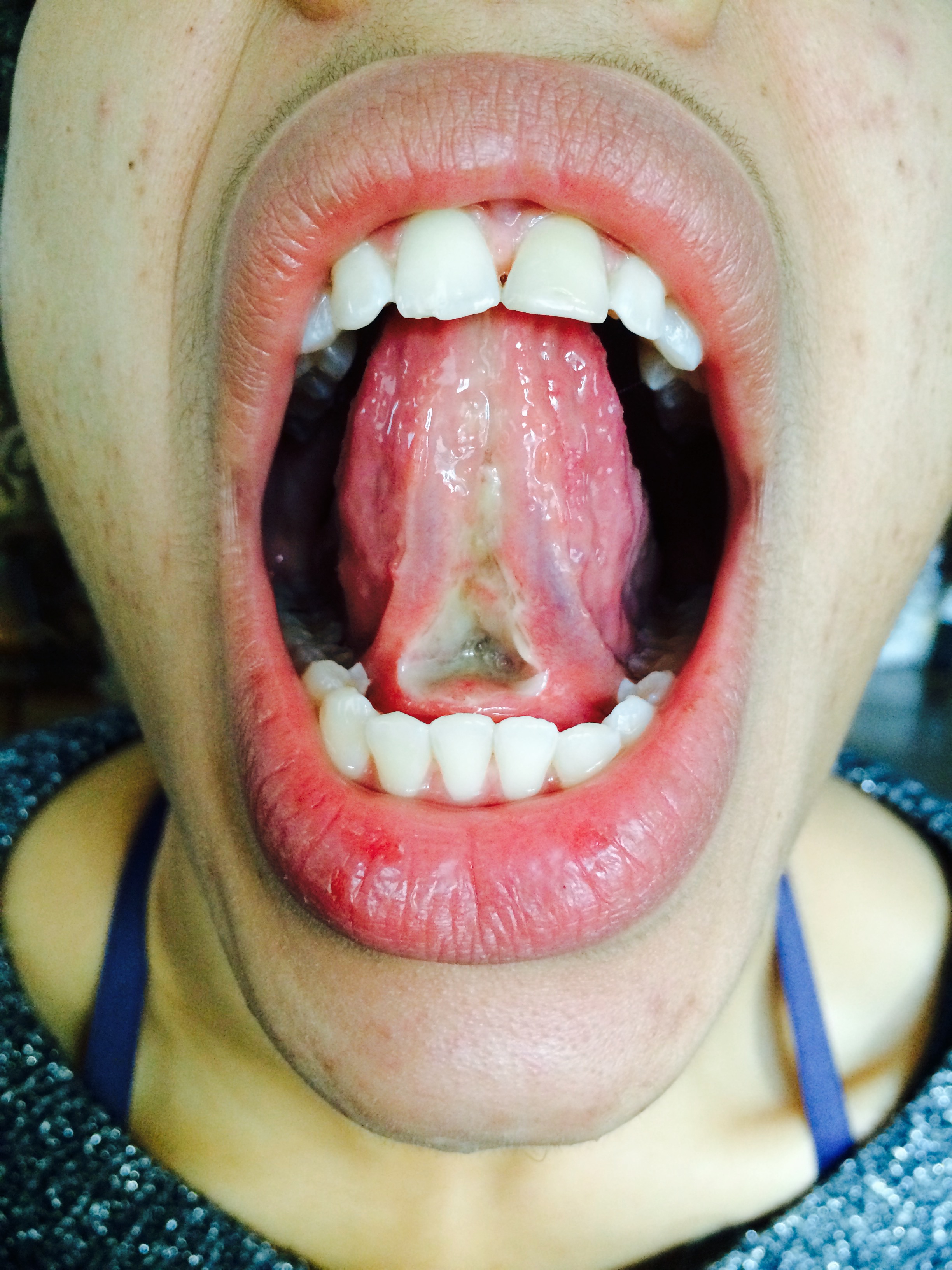 Orofacial Myofunctional Therapy and Frenectomy Judith DemberPaige