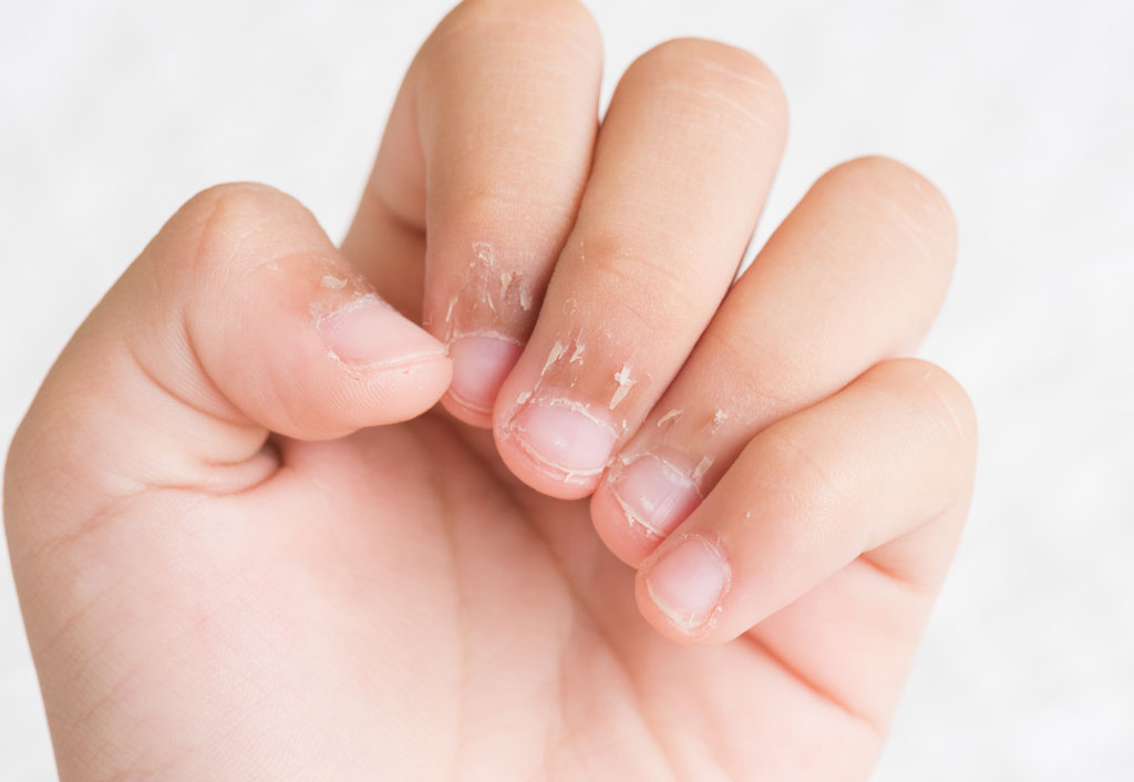 5 Signs of dehydration in kids from dry skin to irritability Coslyte