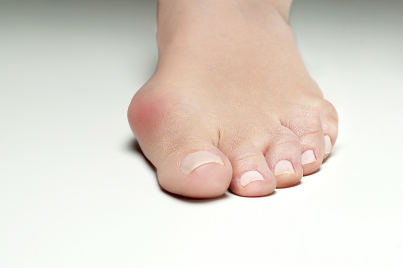 "Hallux valgus" Das schmerzhafte Problem mit dem großen Zeh Orthinform