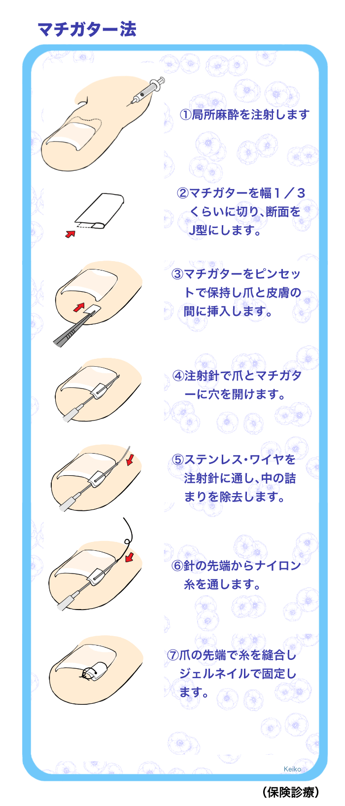 爪と足のケア 喜山整形ハーブクリニック