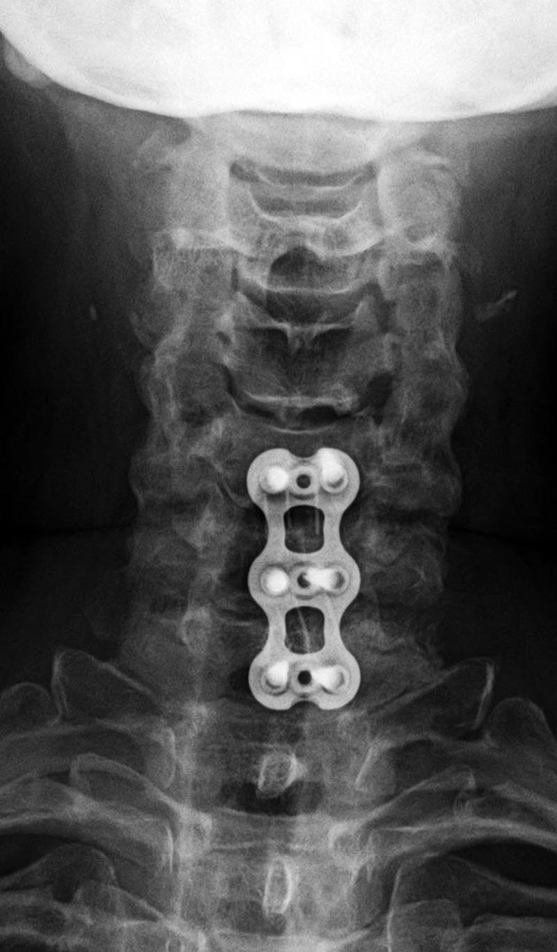 Medical Devices of the Neck and Spine an imaging guide