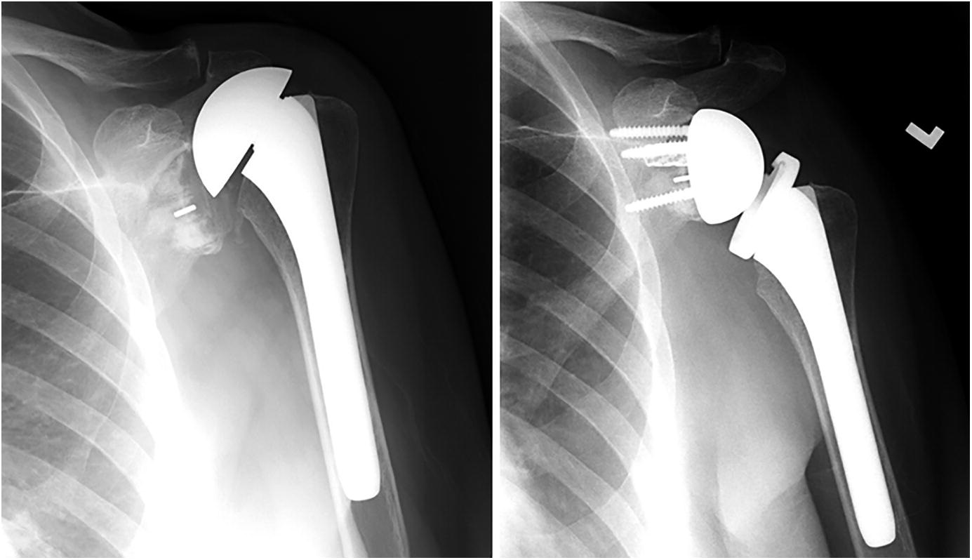 Humeral Stem Retention in Revision Shoulder Arthroplasty OrthoBuzz
