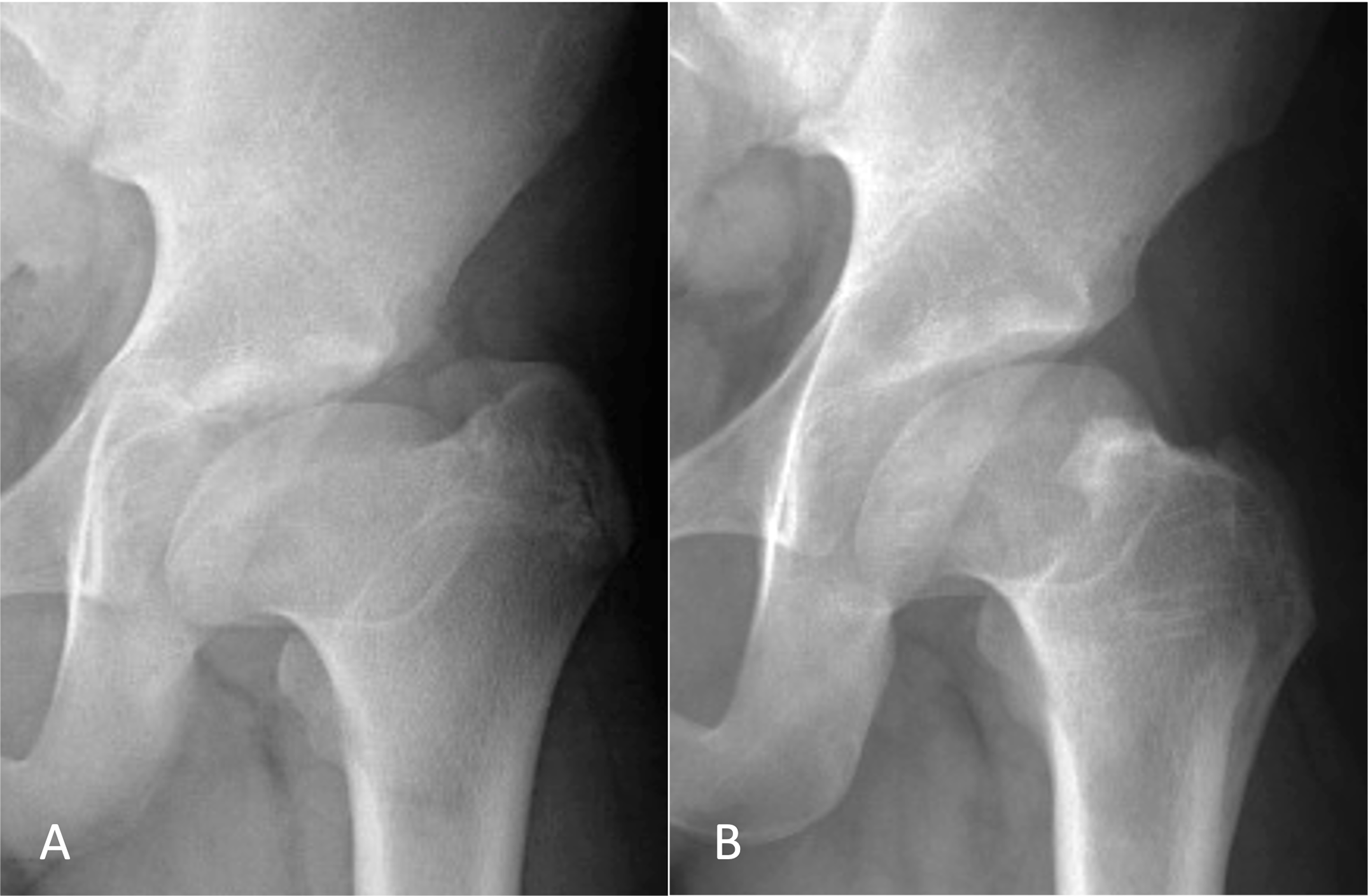 Treating Symptomatic Residual Hip Deformity in LeggCalvéPerthes