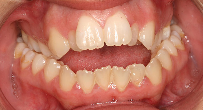 Open bite Orthocenter