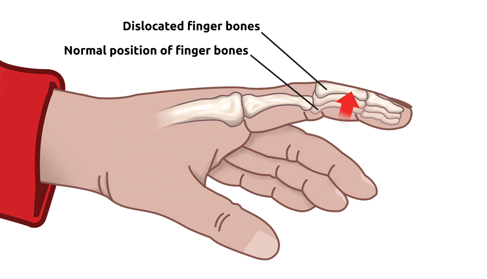 Finger splint for children AM‑D‑02 4Kids Ortezy dla dzieci