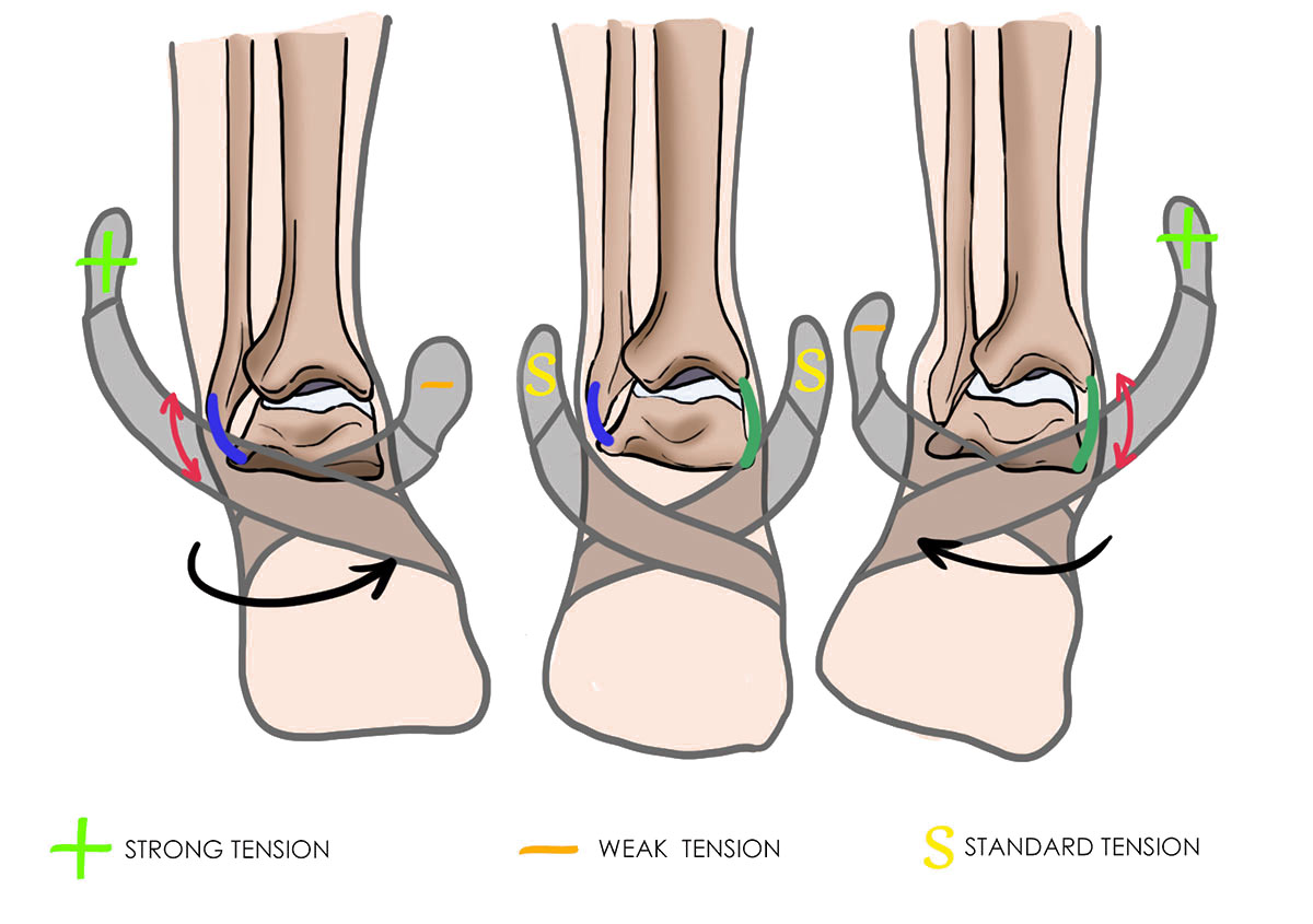 Ankle Pronation Braces