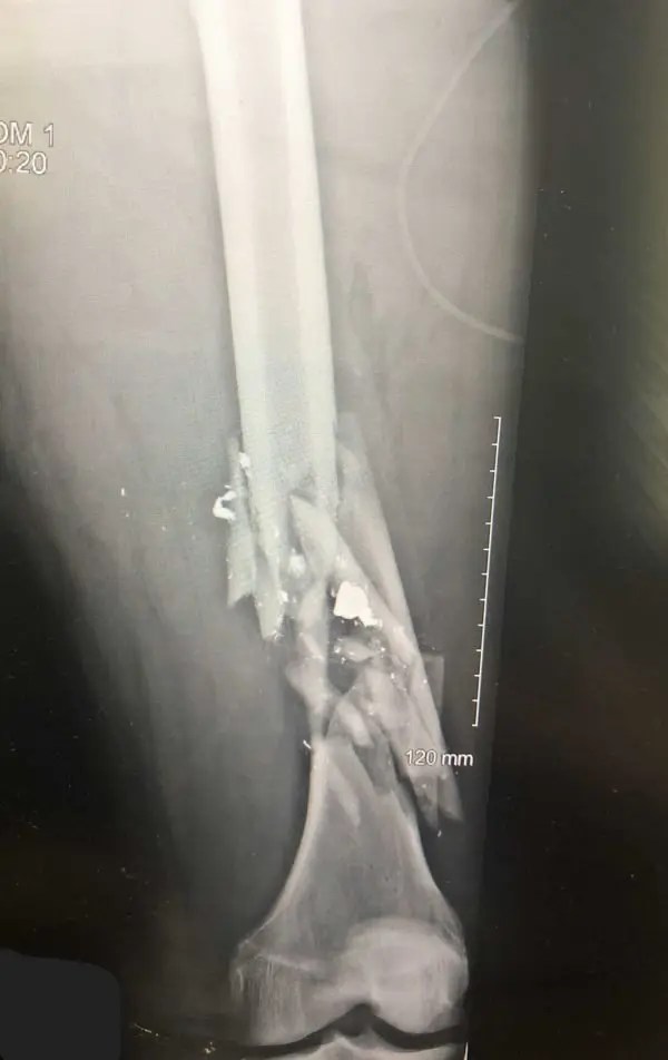 Antibiotic Choice in Open Fractures Ortho Conditioning