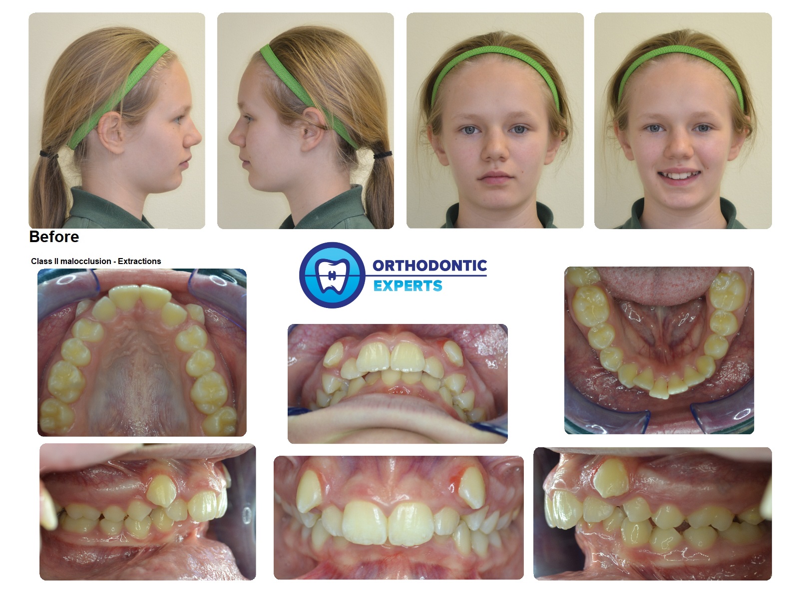 2.Extractions Top Orthodontist Braces, Invisalign
