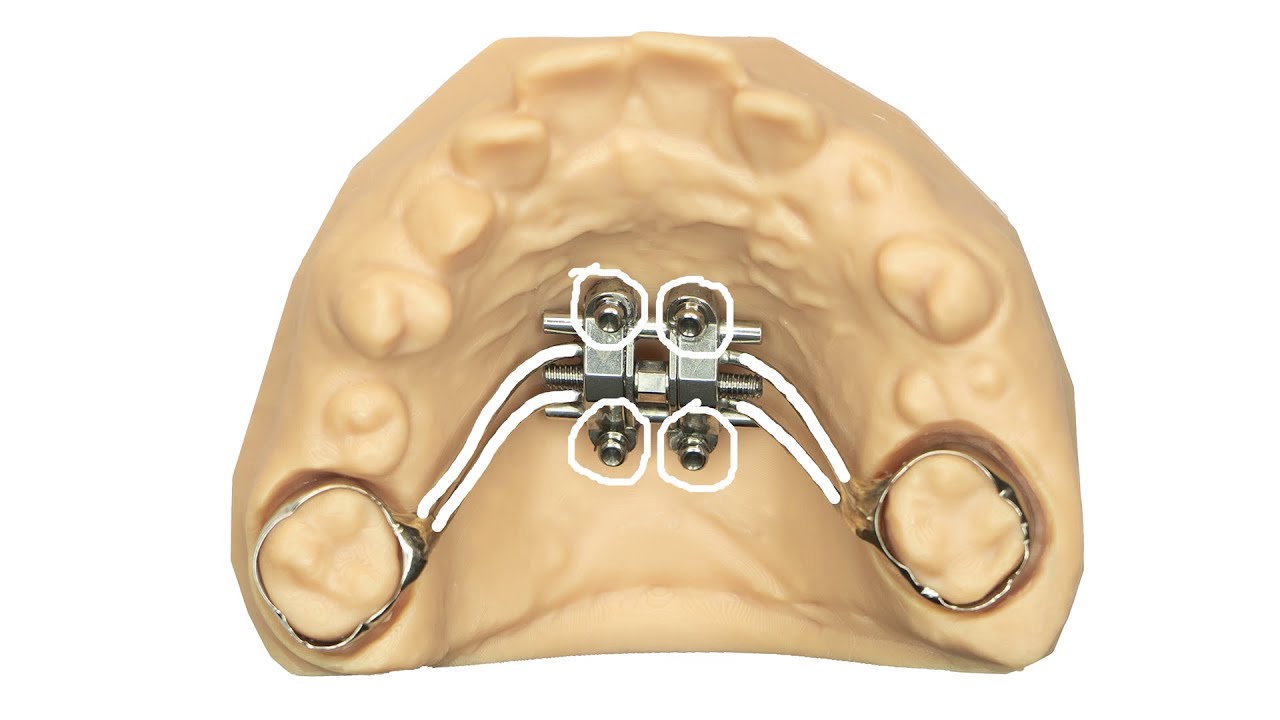 TAD Supported Expansion Appliances Orthodontic Resource Group