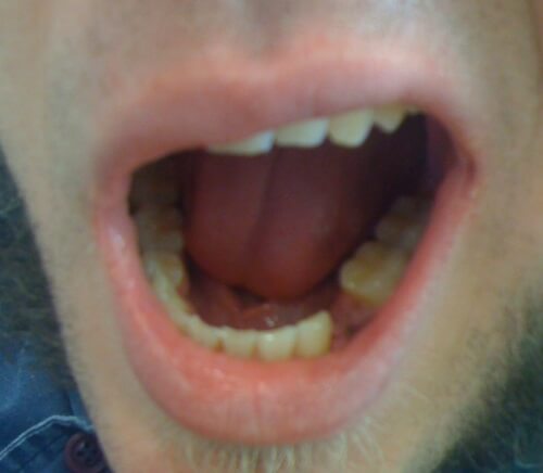 Can You Use Aligners With Missing Teeth Cardiff Alabama