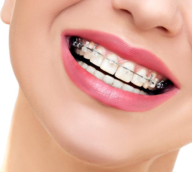 Adult Braces Near Me in Miami Best orthodontist for
