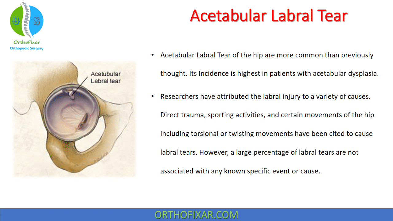 Acetabular Labral Tear OrthoFixar 2024