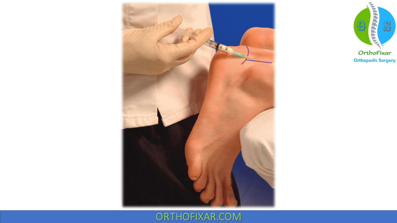 Achilles Tendon Injection OrthoFixar 2024