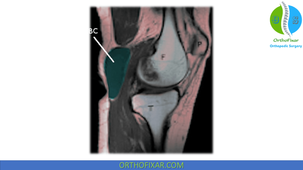 Baker's Cyst Aspiration OrthoFixar 2024