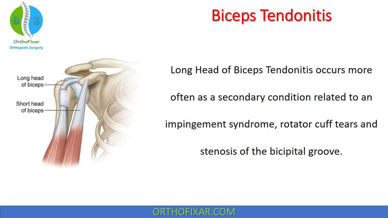 Biceps Tendonitis OrthoFixar 2024