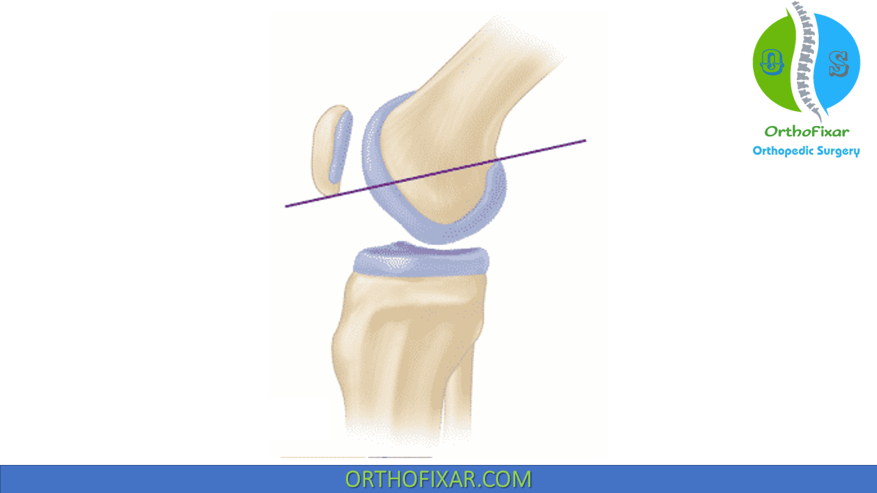 Patellar Instability Easy Explained OrthoFixar 2024