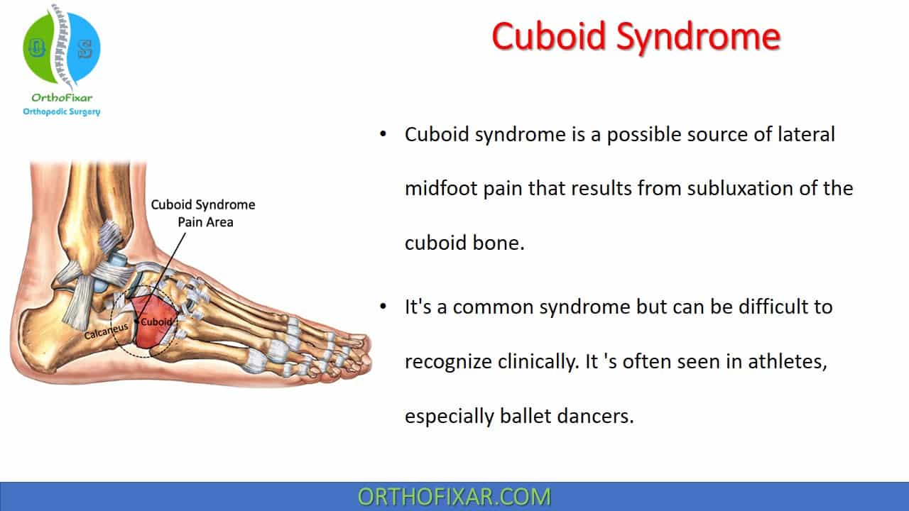 Cuboid Syndrome Easy Explained OrthoFixar 2024