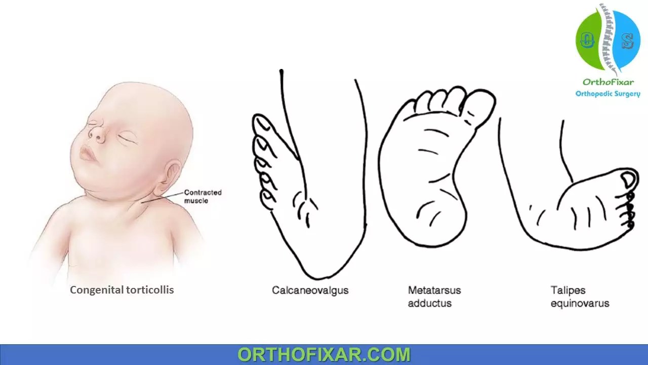 Developmental Dislocation (Dysplasia) Of The Hip (DDH) OrthoInfo AAOS
