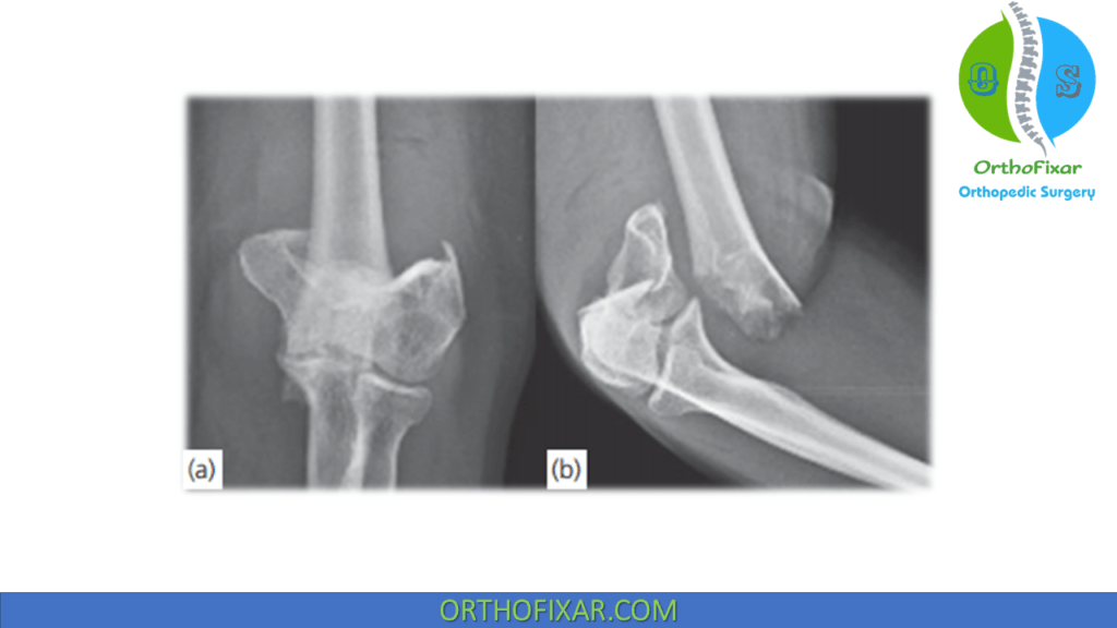 Distal Humerus Fracture OrthoFixar 2024
