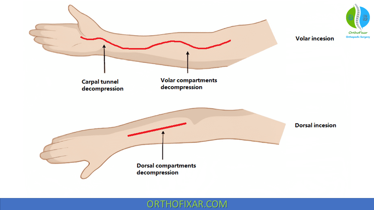 Forearm Fasciotomy