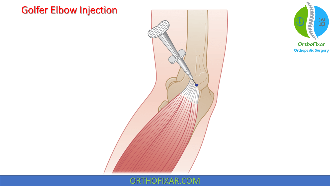 Tennis Elbow Injection OrthoFixar 2024