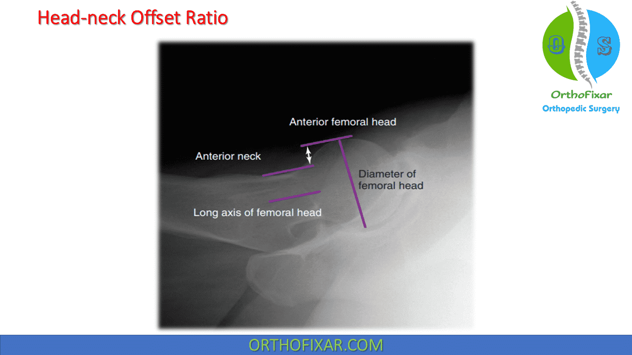 Femoroacetabular Impingement (FAI) OrthoFixar