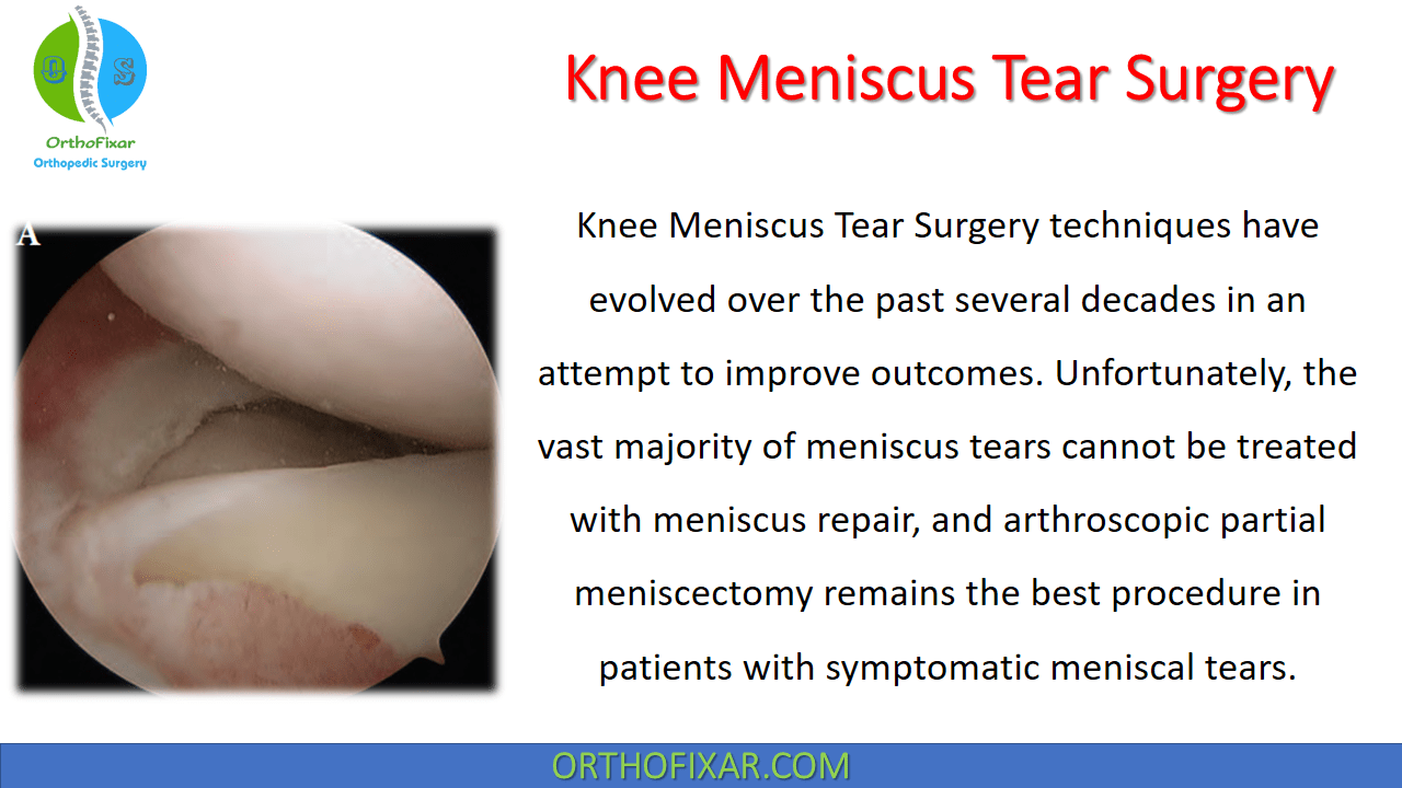Knee Meniscus Tear Surgery OrthoFixar 2024