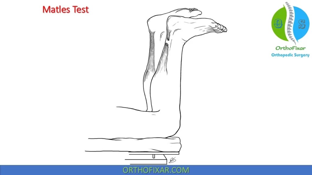Achilles Tendon Rupture Tests OrthoFixar 2024