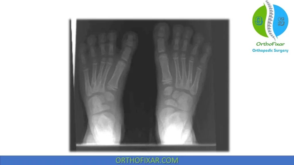 Metatarsus Adductus Easy Explained OrthoFixar 2024