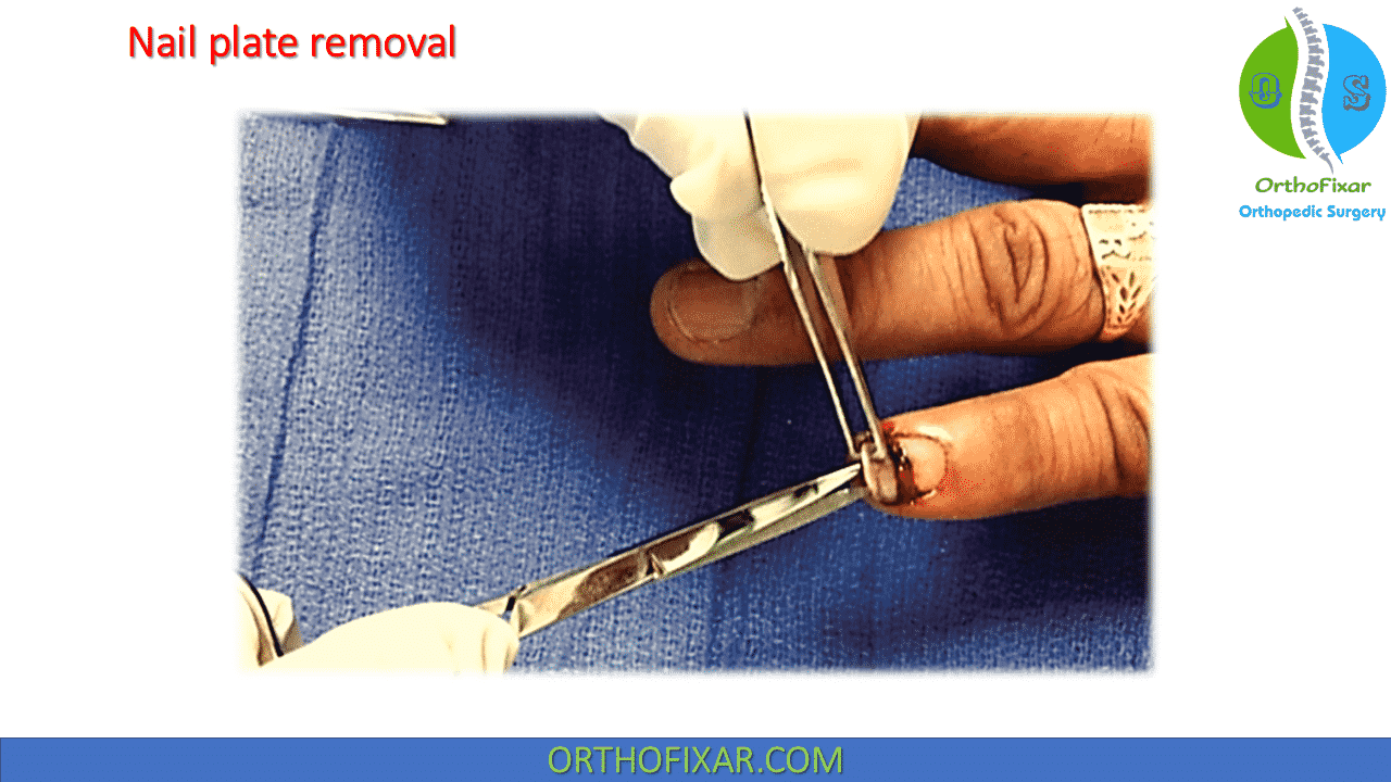 Nail Bed Repair OrthoFixar 2024