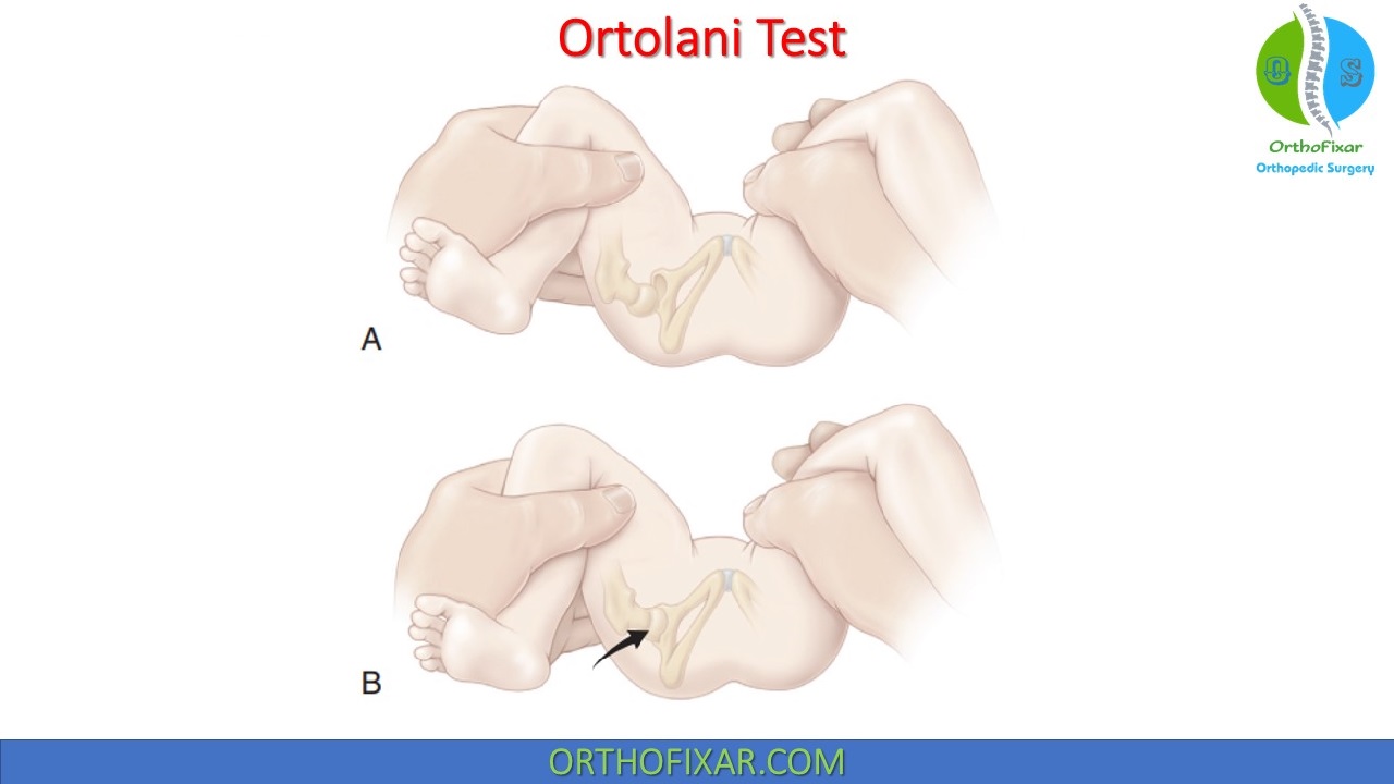 Ortolani Test • Definition • What For • Easy Explained 2021 OrthoFixar