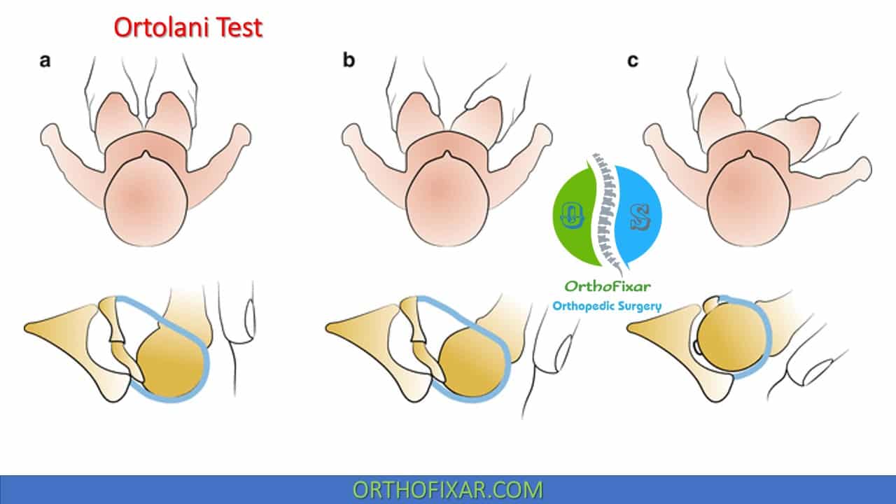 Ortolani Test • Hip Examination 2022 Orthofixar