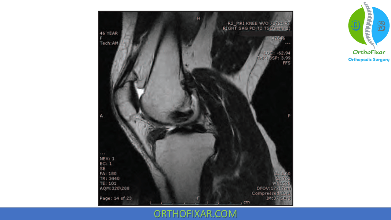 Arthroscopic Knee Synovectomy OrthoFixar 2024