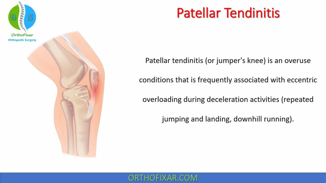 Patellar Tendinitis (Jumper's Knee) OrthoFixar 2024