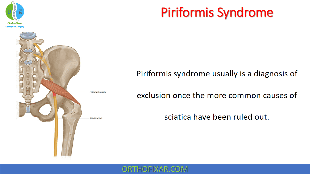Piriformis Syndrome OrthoFixar 2024