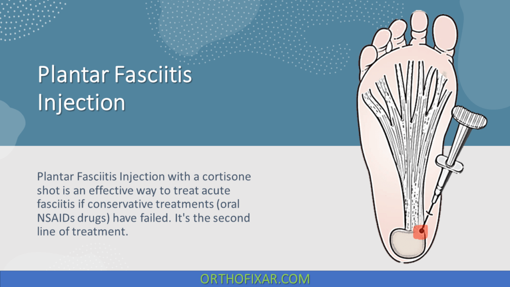 Plantar Fasciitis Injection OrthoFixar 2025