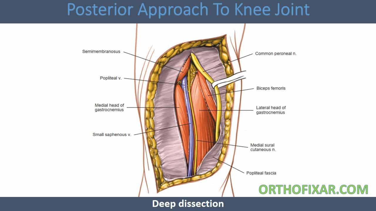 Posterior Approach To Knee Joint | OrthoFixar 2025