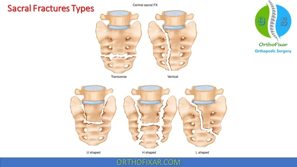 Sacral Fracture OrthoFixar 2024