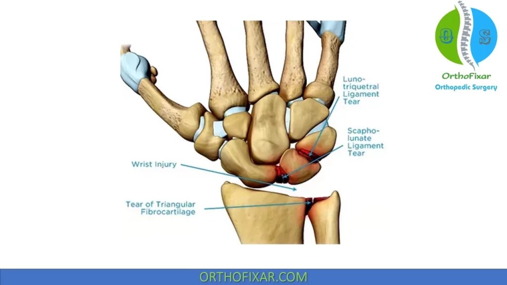 Wrist Pain Causes • Easily Explained OrthoFixar 2024