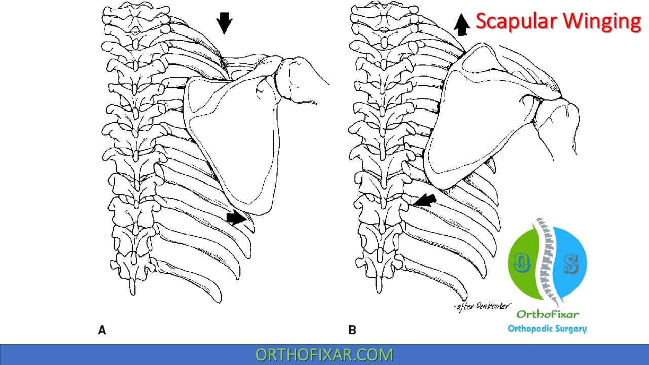 Scapular Winging Types