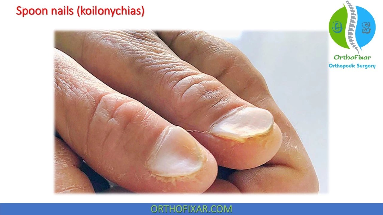 Top more than 107 spoon nails causes latest noithatsi.vn