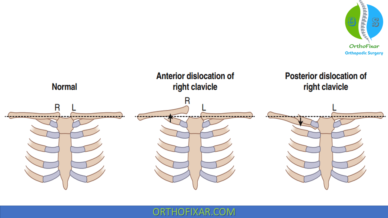 Sternoclavicular Joint Dislocation OrthoFixar 2024