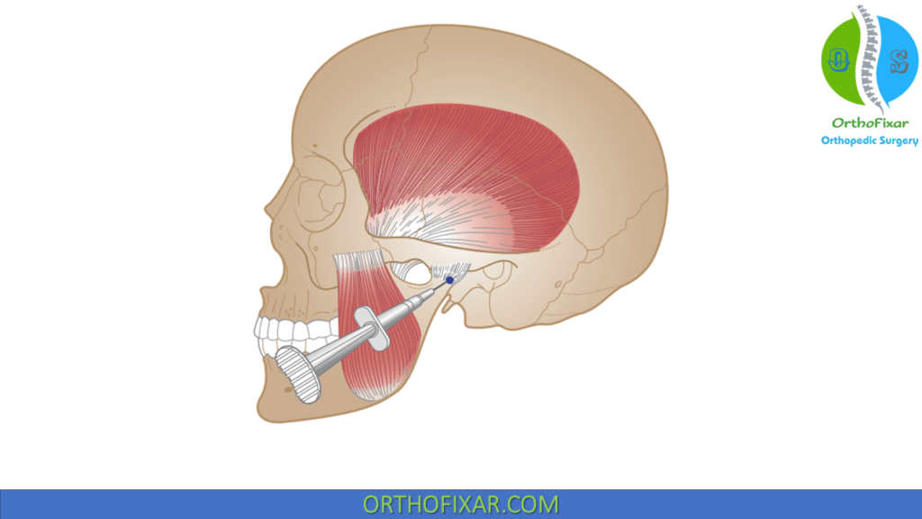 TMJ Injection Technique OrthoFixar 2024