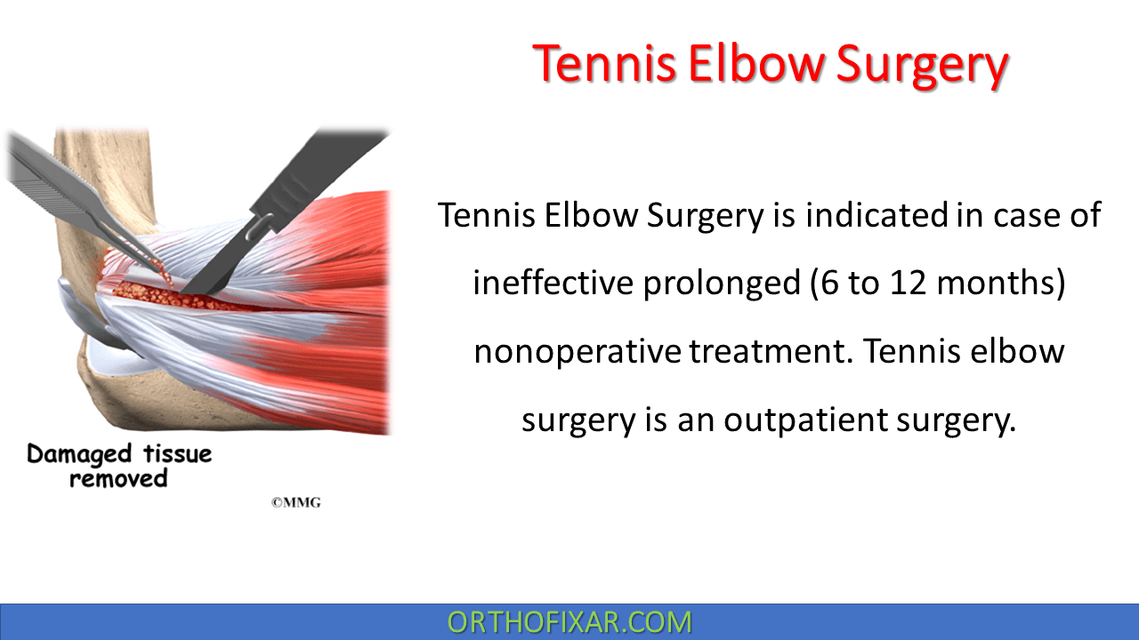 Tennis Elbow Surgery OrthoFixar 2024