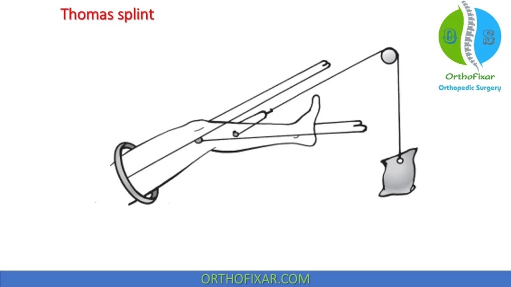 Skeletal Traction Types & Indications OrthoFixar 2024